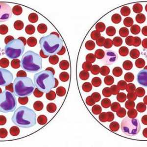 Crvenih krvnih zrnaca smanjen: mogući uzroci