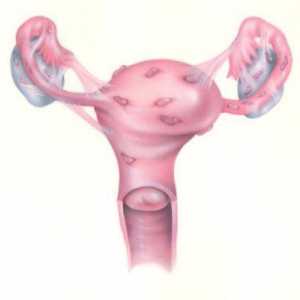Kako tretirati endometrioze? endometrioze: što je to i kako da se zaštite od ove bolesti