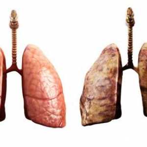 Kako pravilno liječenje upale pluća