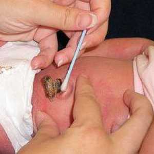 Što je obrada pupka vrši pravilno u novorođenčeta