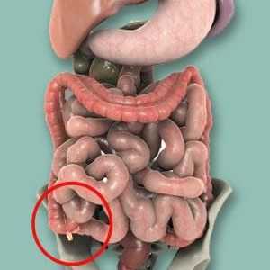Kako prepoznati simptome apendicitis