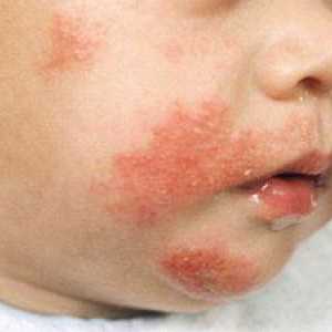 Ono što bi trebalo da bude lijek za djecu od alergija