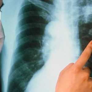 Ono što je najvažnije simptom plućne tuberkuloze?