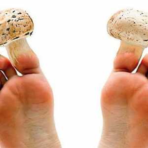 Ono što liječnik tretira noktiju gljiva na noge - mikolog ili dermatologa?