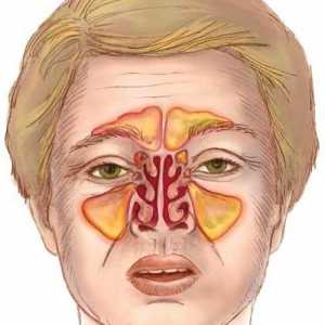 Koji su simptomi upale sinusa? liječenje bolesti