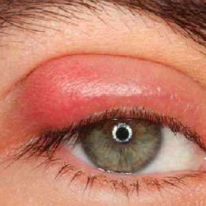 Kapi ječma na oku: izbor uputstva pravo droga