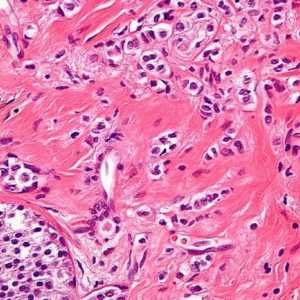 Karcinom - Što je to? planocelularni karcinom