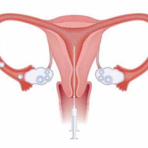 Kada se koristi intrauterine inseminacije?