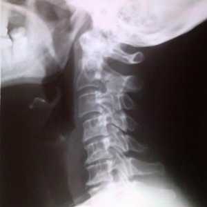 U grlu sa osteohondroze vratne kralježnice: simptomi, liječenje