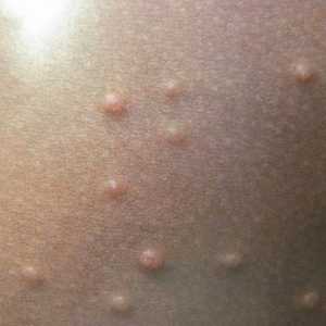 Molluscum contagiosum kod djece, liječenje kože