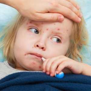 Ospice je dijete: Simptomi i tretman