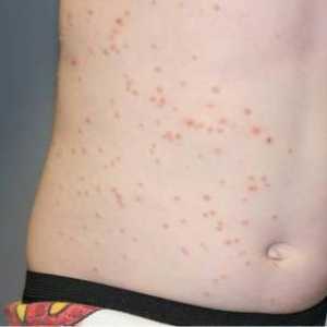 Kožne bolesti - Zarazni mekušaca