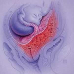 Marginalna placenta previa - opasnost za normalan tok trudnoće