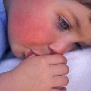 Crvena mrlja na obrazu bebe: uzroci, simptomi i karakteristike tretman