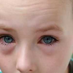 Crvene oči kod djece - prilika konsultovati oftalmolog