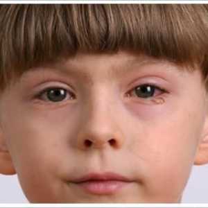 Crvene oči beba: uzroci, liječenje i prevenciju