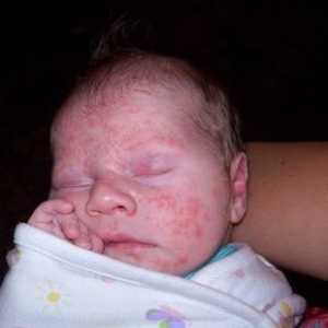 Crvena bubuljice na licu novorođenčeta