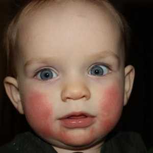 Crveni obrazi kod novorođenčadi: šta da radim? Crveni obrazi kod beba: uzroci, liječenje