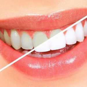 Zubi laminacije: opis postupka, komentari