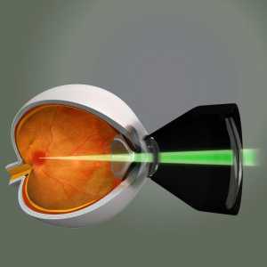 Laser koagulacije retine