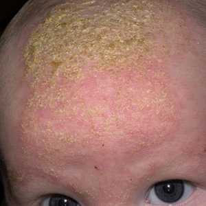 Dermatitis u tretmanu djeteta na osnovu etiologije