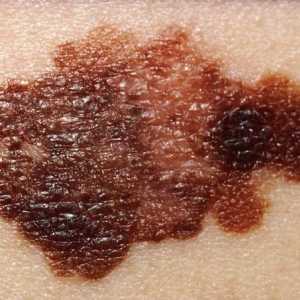 Tretman melanoma: osnovne tehnike