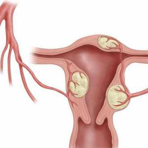 Liječenje mioma uterusa je efikasna folk pravnih lijekova: recenzije