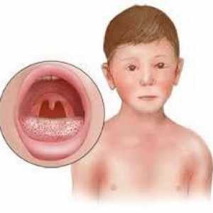 Streptoderma kućno liječenje za djecu i odrasle
