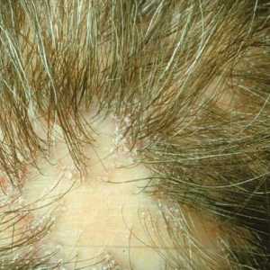 Zoster na glavi: glavne vrste, simptomi i liječenje