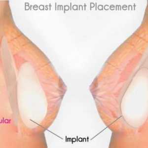 Dojke Implantati "pre" i "posle": rezultati različitih vrsta operacija