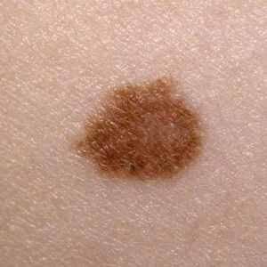 Melanom: Šta je to? Simptomi bolesti, prevenciju i liječenje melanoma