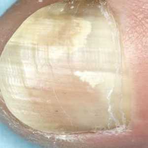 Gljivične infekcije noktiju: kako izbjeći i kako tretirati