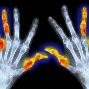ICD 10. Reumatoidni artritis: Simptomi i tretman