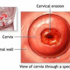 Da li je moguće zamisliti cervikalne erozije: stručna mišljenja i važne činjenice