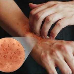 Atopijski dermatitis na rukama: etiologija, klinička liječenja