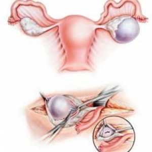 Opstrukcija jajovoda: kako da biste dobili trudna, kako se izliječiti
