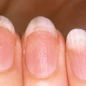 Jagged nokte: uzroci, liječenje
