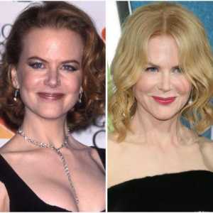 Nicole Kidman prije i nakon plastične (foto)