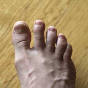 Nokat ispod noktiju i rast - liječenje i prevencija