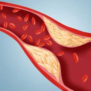 Norma holesterola u krvi muškaraca. Indikatori holesterola u krvi