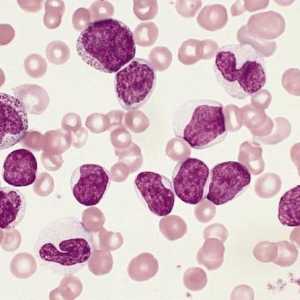 Šta povećala neutrofila u krvi?