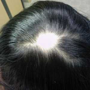 Gubitak kose u žena: Uzroci, liječenje. Znači za ćelavost za žene