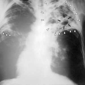 Opasno ukoliko period inkubacije za TB?