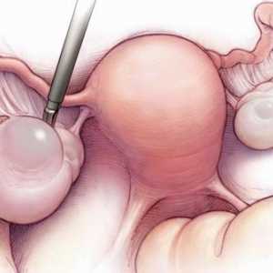 Operaciju uklanjanja jajnika ciste