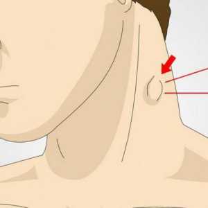Otečene limfne čvorove na vratu: moguće uzroke, simptomi i karakteristike tretman