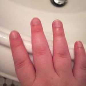 Otečeni prsti: uzroci, dijagnoza, liječenje. Šta ako otečeni zglobovi prstiju