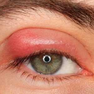 Otečeni gornjih očnih kapaka: uzroci i metode da se oslobodimo problema