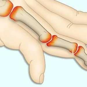Glavni simptomi reumatoidnog artritisa