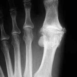 Osteoartritisa stopala: uzroci, simptomi i metode tretiranja