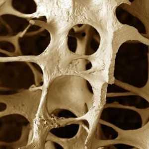Osteopenija - šta je to i šta su tretmani